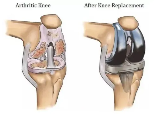 Replacement (Arthroplasty) In Dadar service image