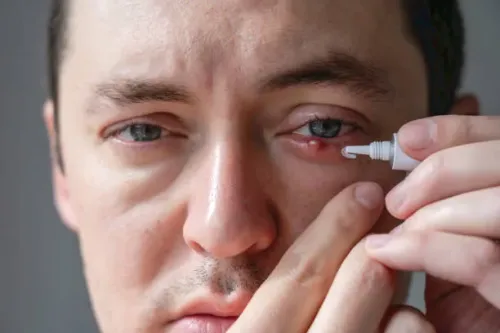 Chalazion Treatment service image