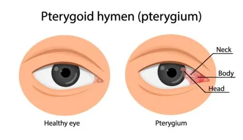 Pterygium Management service image