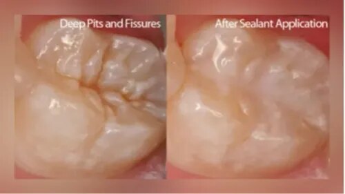 Pit and Fissure Sealants service image