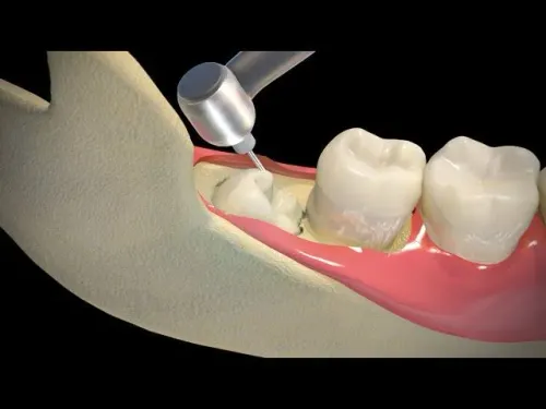 Wisdom tooth Removal service image