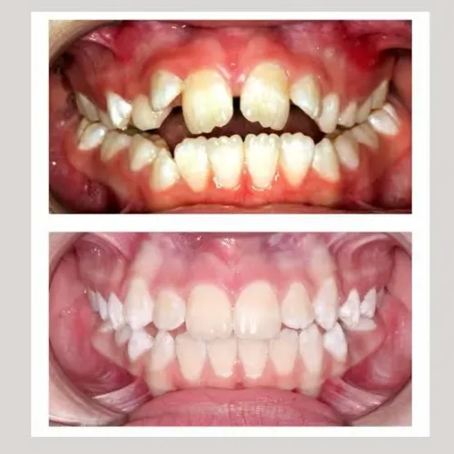 Allignment of teeth service image