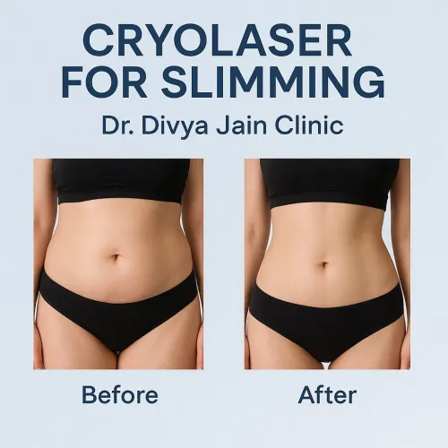 Cryolaser For Slimming service image