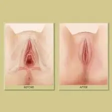 Vaginal Tightening service image