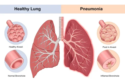 Pneumonia Treatment service image