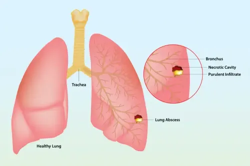 Lung Infection Management  service image