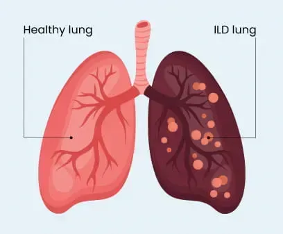 Interstitial Lung Disease (ILD) Treatment service image