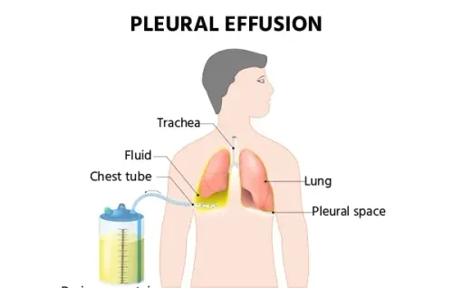 Pleural Effusion Management service image