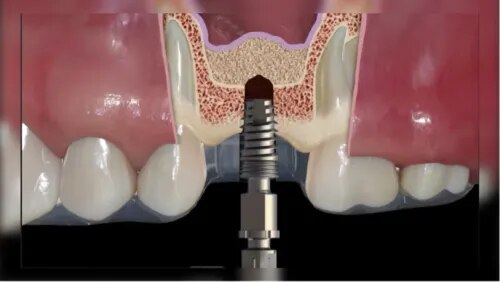 Indirect Sinus Lift Surgery service image