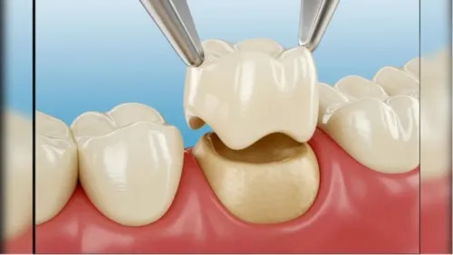 Zirconia Crowns service image