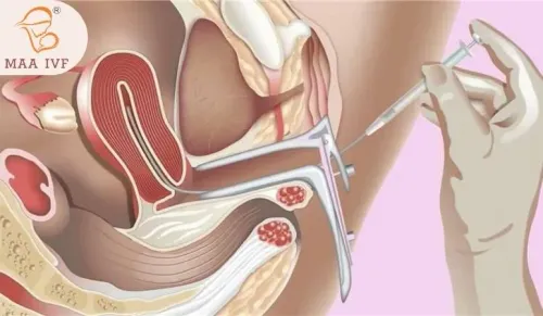 INTRA UTERINE INSEMINATION (IUI) service image
