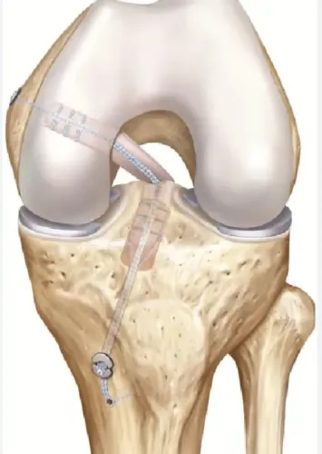 PCL Repair Surgery service image