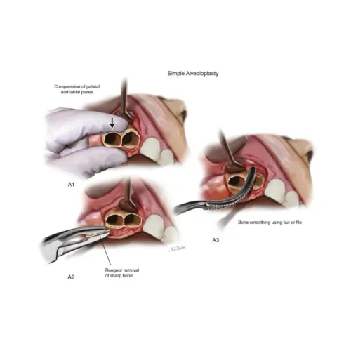 Alveoloplasty  service image