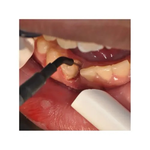 Electrocautery  service image