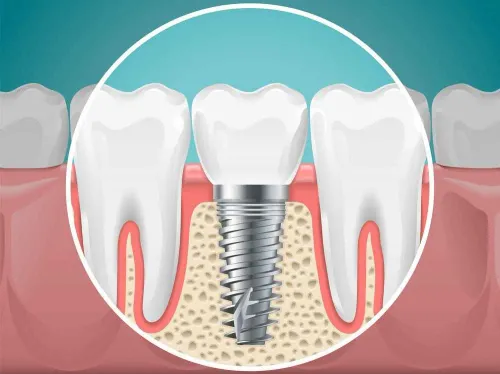 Dental Implant service image