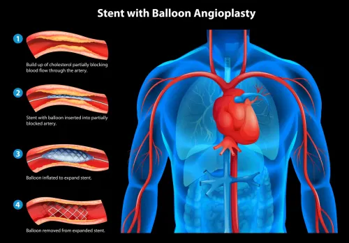 Stent Placement Treatment service image