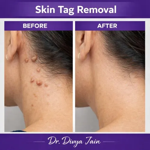 Skin Tag Removal service image