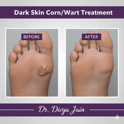 Dark Skin Corn/Wart service image