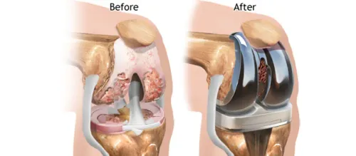 Joint Replacement Surgery service image