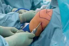 shoulder Arthroscopy surgery service image