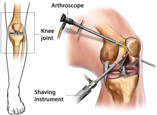 Knee arthroscopy service image