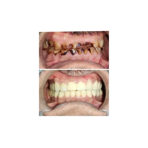 Full Mouth Rehabilitation  service image
