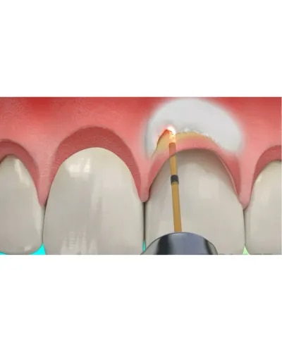 Laser Crown Lengthening  service image