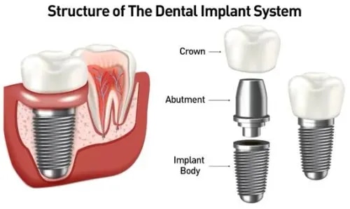 Dental Implant service image