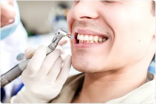 Teeth Cleaning and Polishing Treatment in Bhugaon, Bhukum, Pirangut  service image