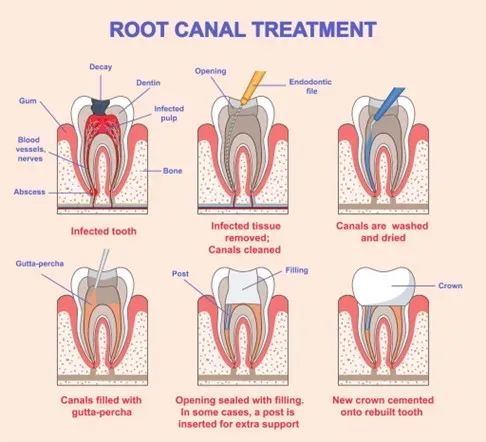 Root Canal Treatment service image