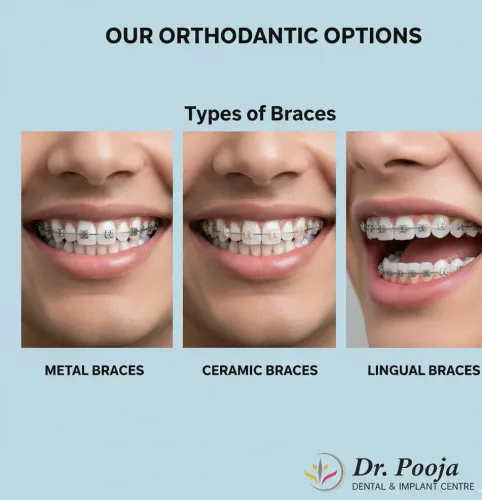 Braces product image