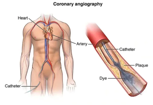 Best Angiography Hospital in Warje, Pune, PCMC  service image