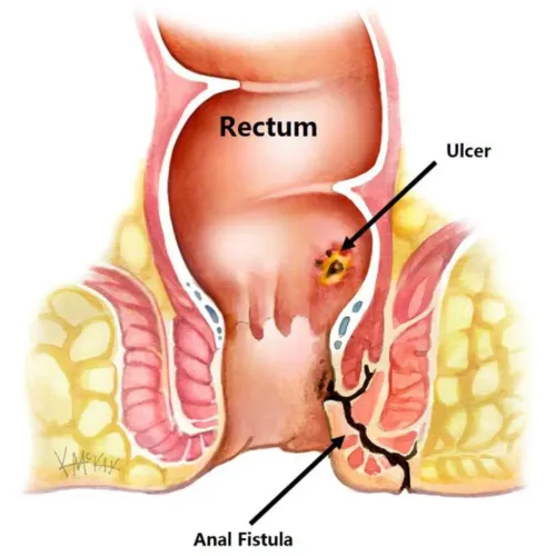  Fistula Treatment service image