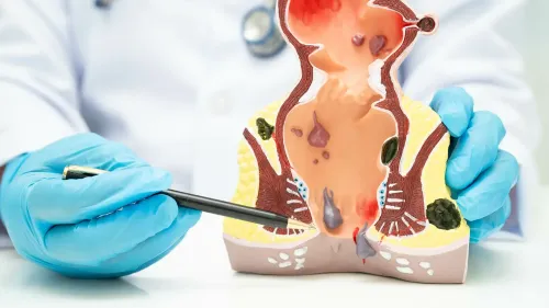 Piles Surgery service image