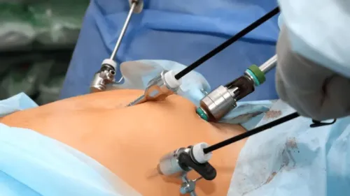 Laparoscopic Colon Surgery service image