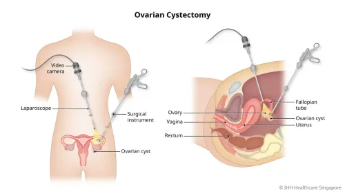 Laparoscopic Ovarian Cyst Removal service image