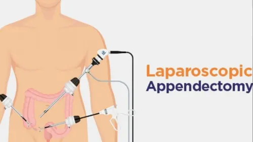 Laparoscopic Appendectomy service image