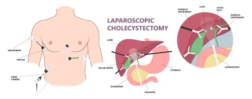 Laparoscopic Cholecystectomy service image