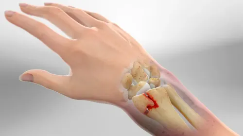 Wrist Fracture Treatment service image