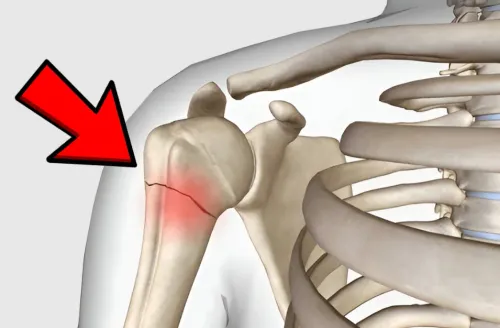 Humerus Fracture Treatment service image