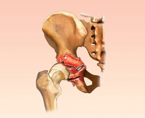 Acetabulum Fracture Treatment service image