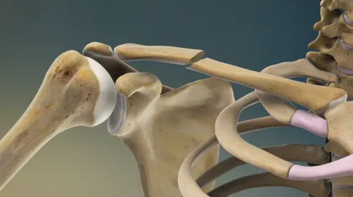 Clavicle Fracture Treatment service image