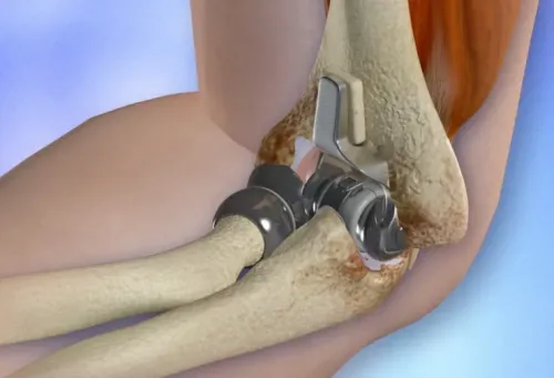 Elbow Replacement service image