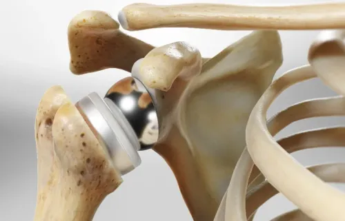 Reverse Shoulder Replacement service image