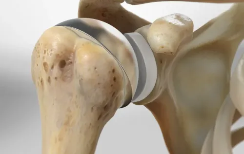 Total Shoulder Replacement service image