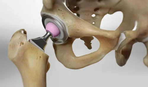 Total Hip Replacement service image