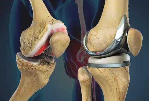 Total Knee Replacement service image