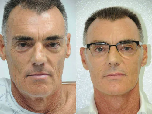 Face Lift Surgery service image