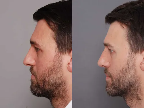 Nose Job (Rhinoplasty) service image