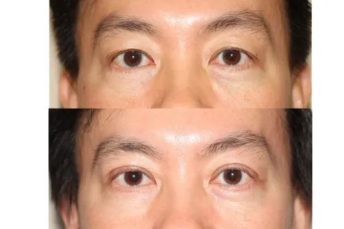Eyelid Surgery (Blepharoplasty) service image